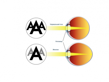 Превью публикации Жизнь с миопией: виды, симптомы и лечение